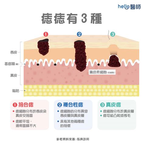 痣長毛